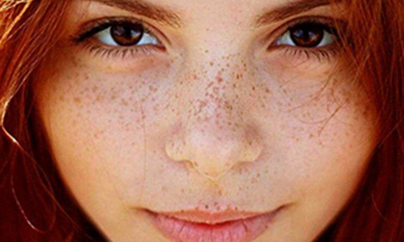 Por que salen las pecas en la piel Por que salen las pecas en la piel