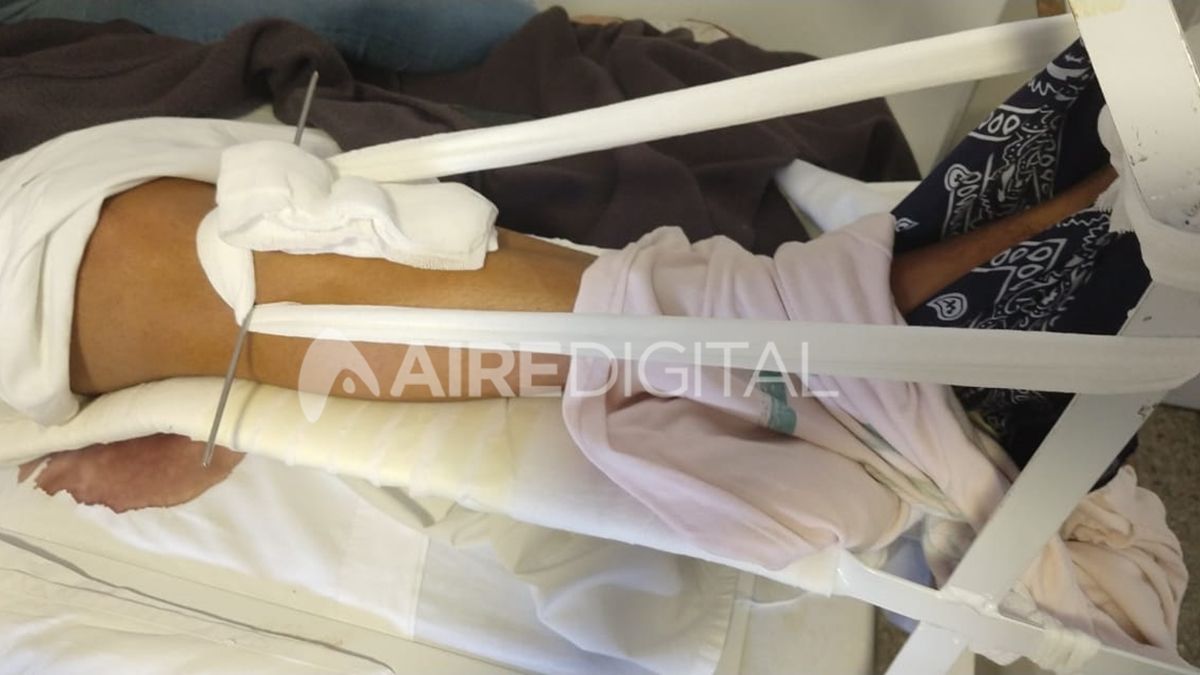 La bala le fracturó el fémur al joven, que permanece en reposo intentando recuperarse de la herida.