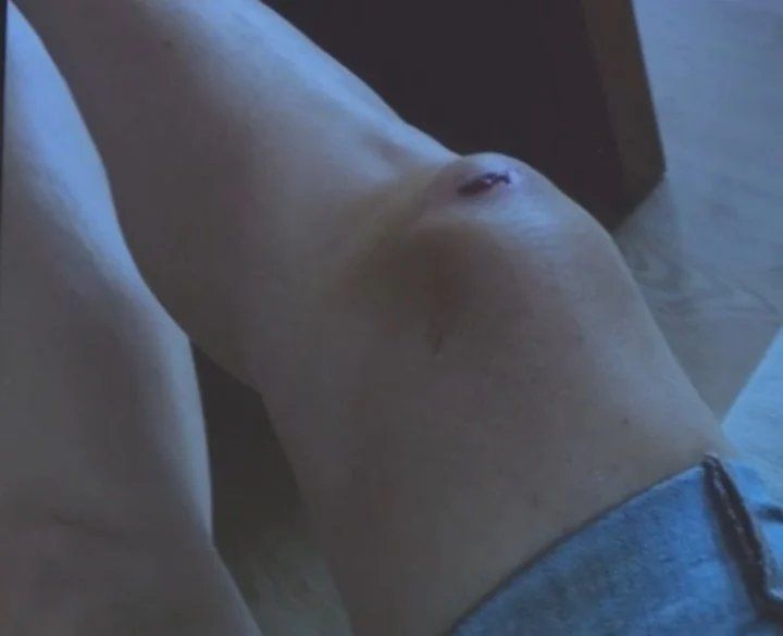 El fuerte golpe que sufrió Yanina Latorre en su rodilla derecha.