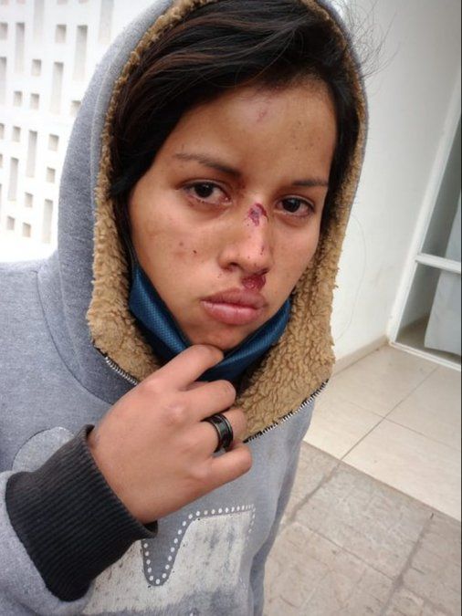 Una joven que sufrió heridas a partir del accionar policial