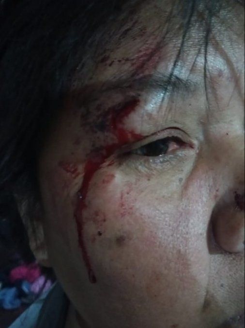 La mujer herida por el golpe de la policía.