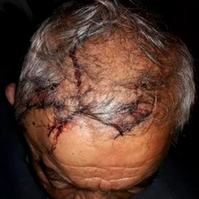Al hombre de 74 a&ntilde;os debieron cerrarle las heridas con 18 puntos de sutura