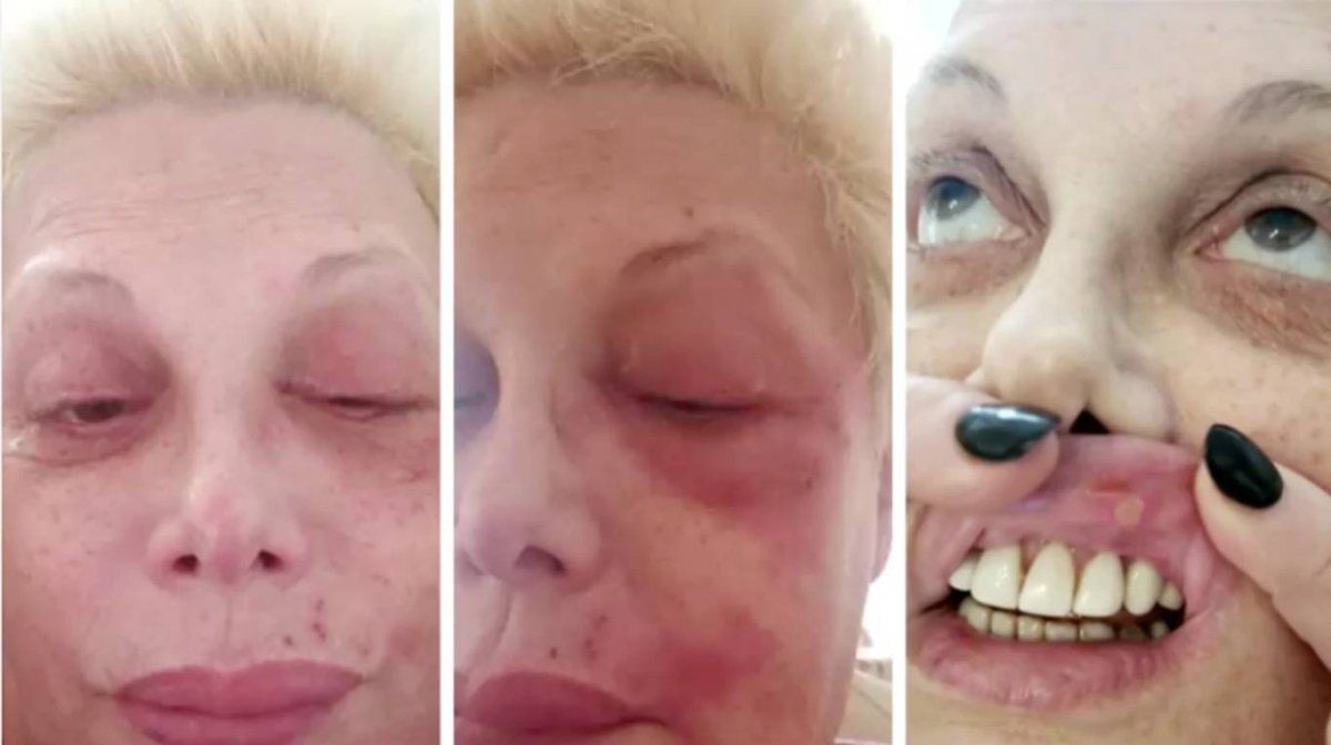 Así le quedó el rostro a Carmen Barbieri por la culebrilla.