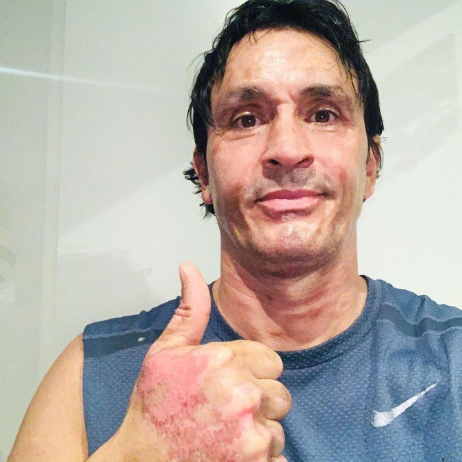 Así quedó Sebastián Estevanez tras el accidente doméstico.