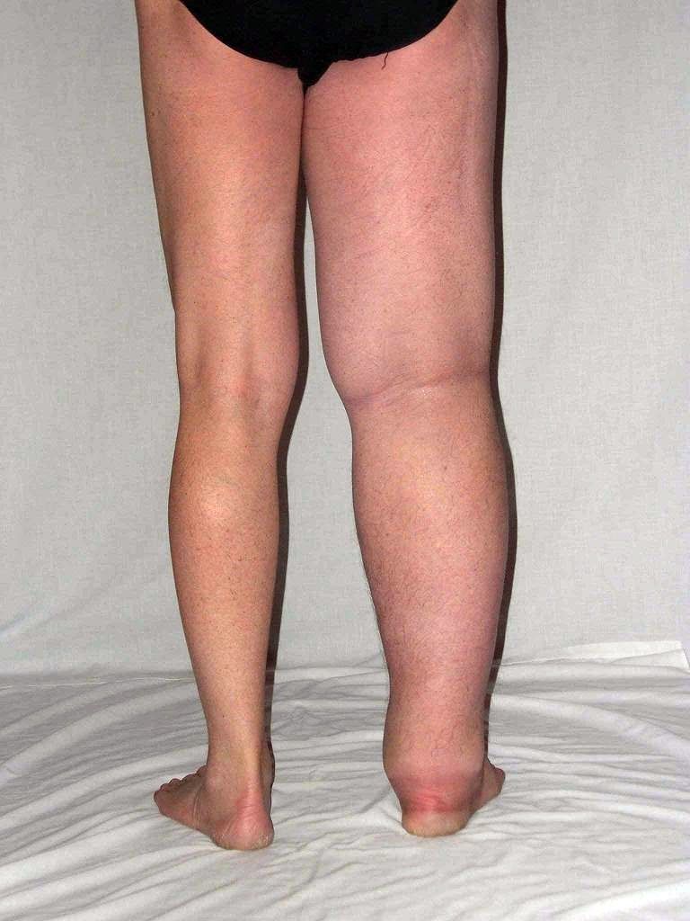 Resultado de imagen para linfedema