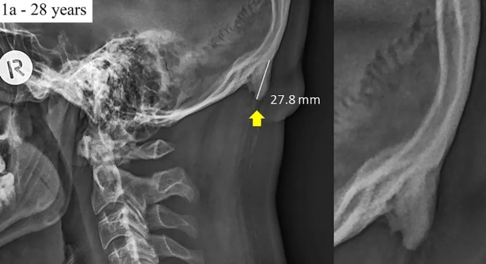 ¿Sabes cómo acabará tu columna de tanto usar WhatsApp?