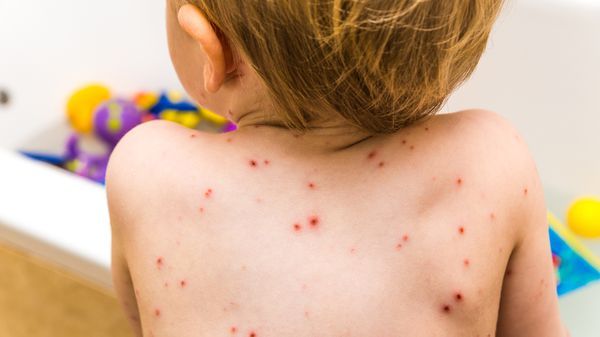 La varicela es una enfermedad producida por el virus Varicela-Zoster (SMG Center)