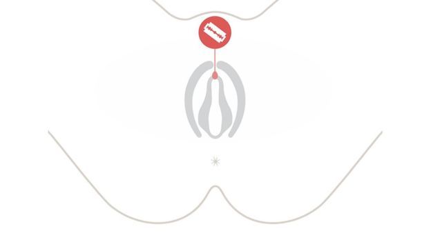 Gráfico que muestra la clitoridectomía