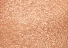 Resultado de imagen para escamas en la piel