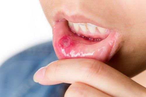 Persona mostrando una llaga bucal