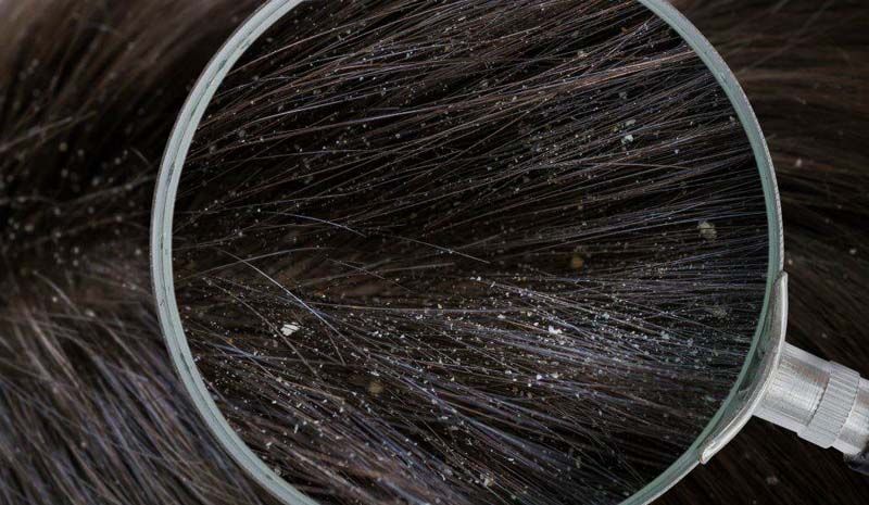 Resultado de imagen para caspa