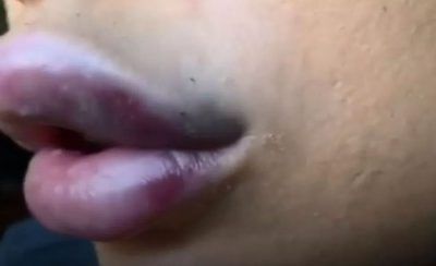 Los labios hinchados tras el tratamiento de belleza