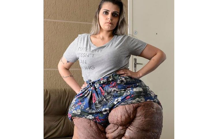 Karina comenzó su condición con lunares oscuros en su piel.