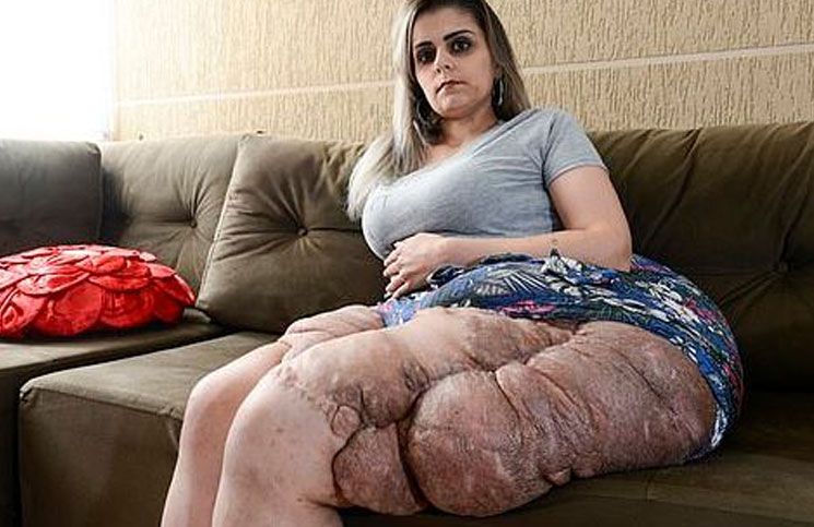 Karina se sometió a procedimientos para quitar los tumores.