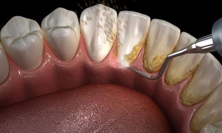 La mejor forma de eliminar y prevenir el sarro de los dientes. La mejor forma de eliminar y prevenir el sarro de los dientes.