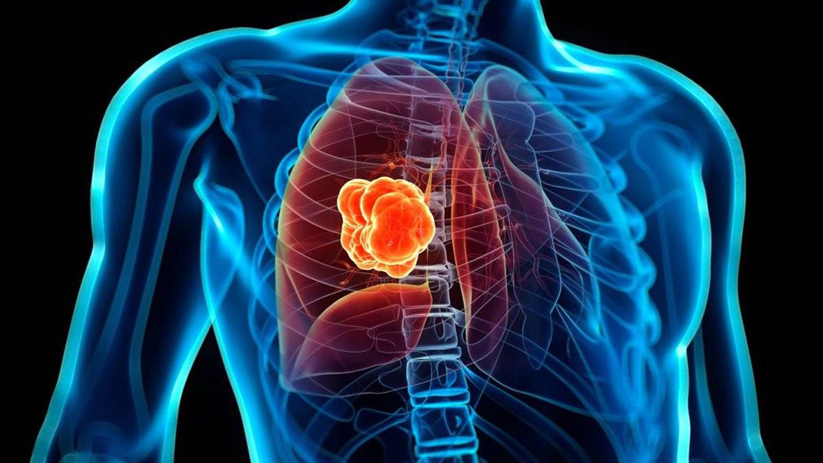 Cada 17 de noviembre se conmemora el día del cáncer de pulmón y se recuerda la importancia sobre la detección temprana y los tratamientos oportunos de uno de los cánceres más mortales y comunes a nivel mundial.