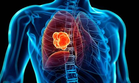 Cada 17 de noviembre se conmemora el día del cáncer de pulmón y se recuerda la importancia sobre la detección temprana y los tratamientos oportunos de uno de los cánceres más mortales y comunes a nivel mundial. Cada 17 de noviembre se conmemora el día del cáncer de pulmón y se recuerda la importancia sobre la detección temprana y los tratamientos oportunos de uno de los cánceres más mortales y comunes a nivel mundial.