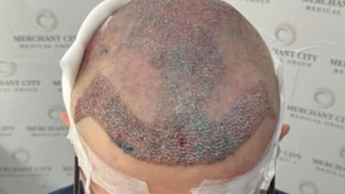 Un hombre viajó a Turquía para hacerse un trasplante de pelo, se descompensó en medio de la operación y murió instantes después de ser trasladado al hospital.