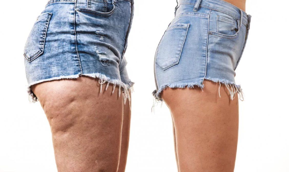 5 alimentos que parecen inofensivos, pero pueden empeorar la celulitis