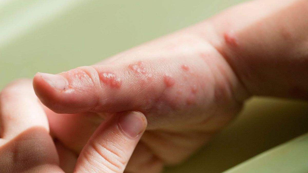 La viruela símica, enfermedad infecciosa causada por un virus del mismo nombre, puede provocar una erupción dolorosa, inflamación de los ganglios linfáticos y fiebre. La viruela símica, enfermedad infecciosa causada por un virus del mismo nombre, puede provocar una erupción dolorosa, inflamación de los ganglios linfáticos y fiebre.