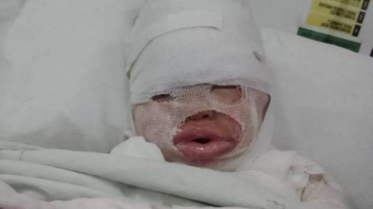 Evoluciona estable niña que se quemó el cuerpo luego de que le volcaran aceite hirviendo en un bar