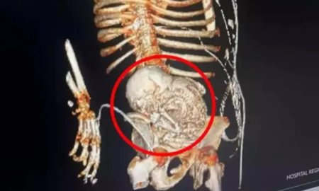 Descubrieron bebé calcificado en mujer tras 30 años. Descubrieron bebé calcificado en mujer tras 30 años.