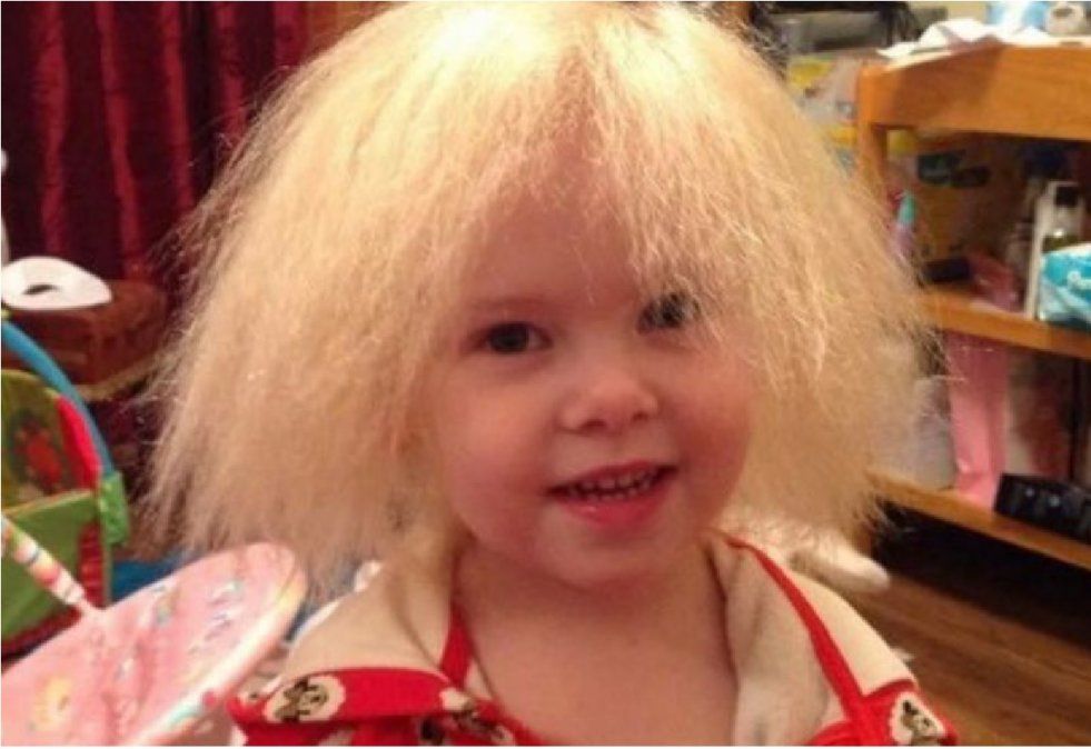 Lyla Grace: la nena que no se pudo peinar en 9 años debido a una extraña enfermedad