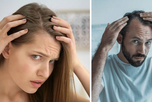 La pérdida de cabello es una de las consultas más frecuentes en dermatología.