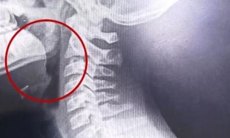 Tras una exitosa laringoscopía, los médicos extrajeron un filamento de alambre que se encontraba oculto en el interior de una galletita de agua comercial. Tras una exitosa laringoscopía, los médicos extrajeron un filamento de alambre que se encontraba oculto en el interior de una galletita de agua comercial.