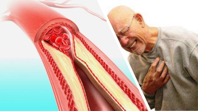 6 remedios naturales para destapar las arterias