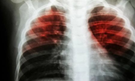 El Ministerio de Salud Pública de Corrientes dio a conocer este martes que la joven de 17 años, que murió a causa de una tuberculosis, era de la capital y concurría al colegio General San Martín.