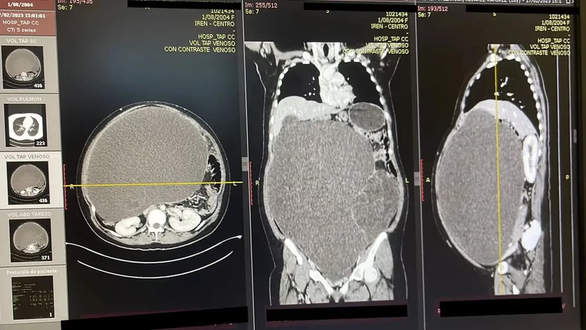 La paciente tenía un tumor de 20 kg. en su abdomen. Su hinchazón estomacal se había atribuido a la obesidad.