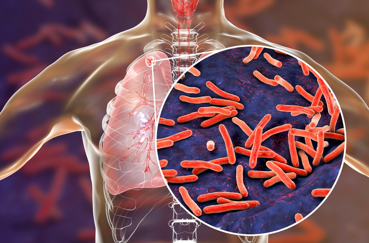 La tuberculosis es una enfermedad bacteriana infecciosa, potencialmente grave, que afecta principalmente a los pulmones. &nbsp;