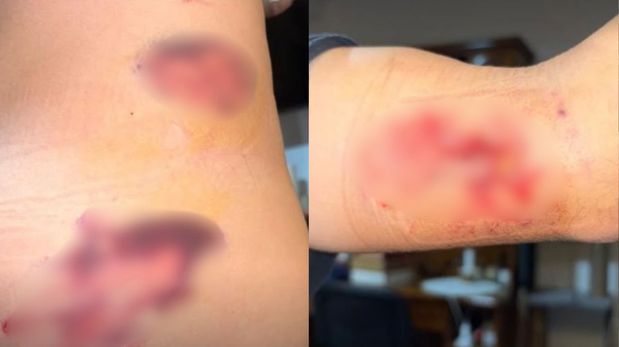 Un trabajador de la Empresa Provincial de la Energía (EPE) fue brutalmente atacado por varios perros mietras trabajaba.