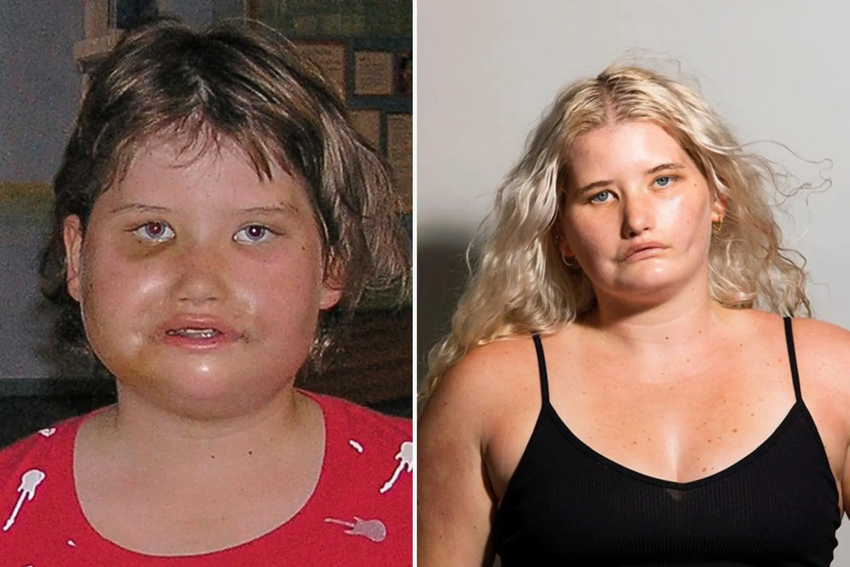 Tayla Clement (24) de Nueva Zelanda, quien es conocida como “la chica que no puede sonreír".