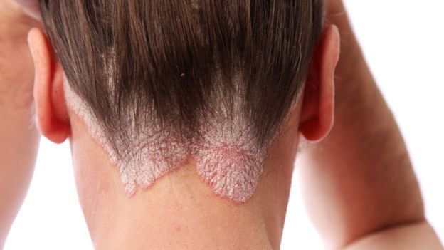92083343_psoriasis1.jpg