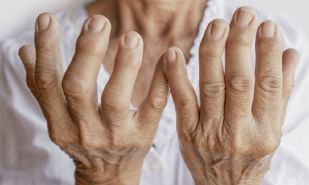 4 terapias naturales para los síntomas de la artritis