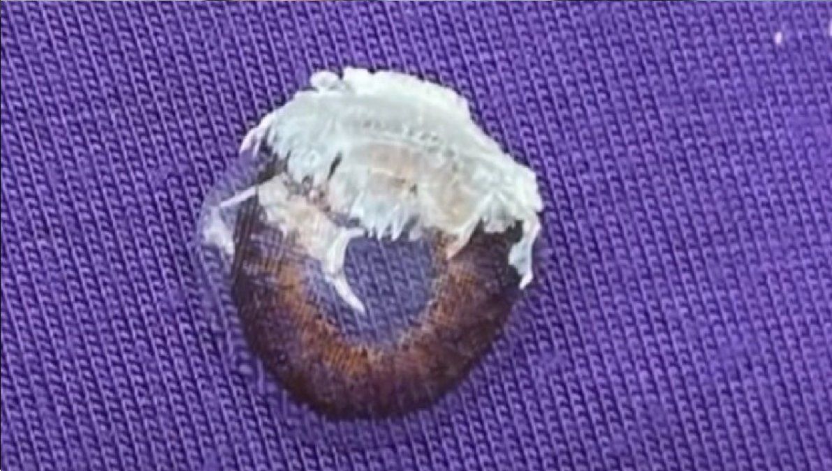 Concurrió en forma urgente al hospital y pudieron retirarle el producto.