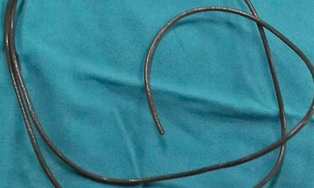 No podía orinar y lo que encontraron en su vejiga sorprendió a los médicos: Lo hacía por placer sexual No podía orinar y lo que encontraron en su vejiga sorprendió a los médicos: Lo hacía por placer sexual