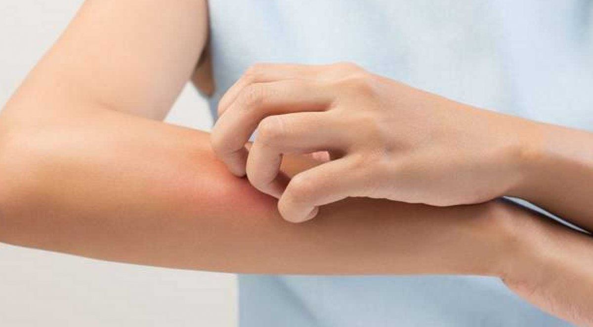 La dermatitis atópica es una enfermedad multifactorial, donde los pacientes tienen susceptibilidad genética.