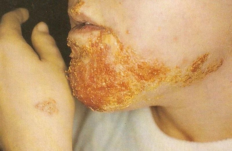 Un hombre de California se contagió de una infección cutánea que le provocó una bacteria "comecarne"