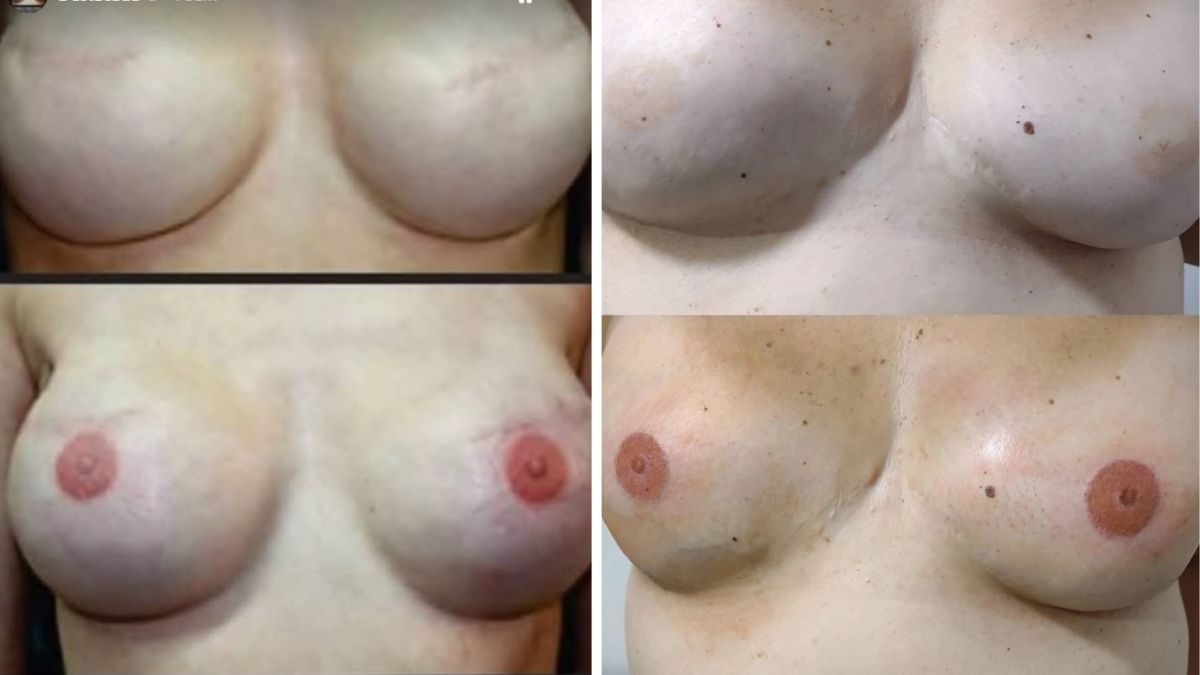 Dos ejemplos del trabajo que realiza la Fundación Mandinga Tattoo en mujeres que sufrieron cáncer de mama. En su local de tatuajes también funciona un consultorio médico para la prevención del cáncer. Dos ejemplos del trabajo que realiza la Fundación Mandinga Tattoo en mujeres que sufrieron cáncer de mama. En su local de tatuajes también funciona un consultorio médico para la prevención del cáncer.
