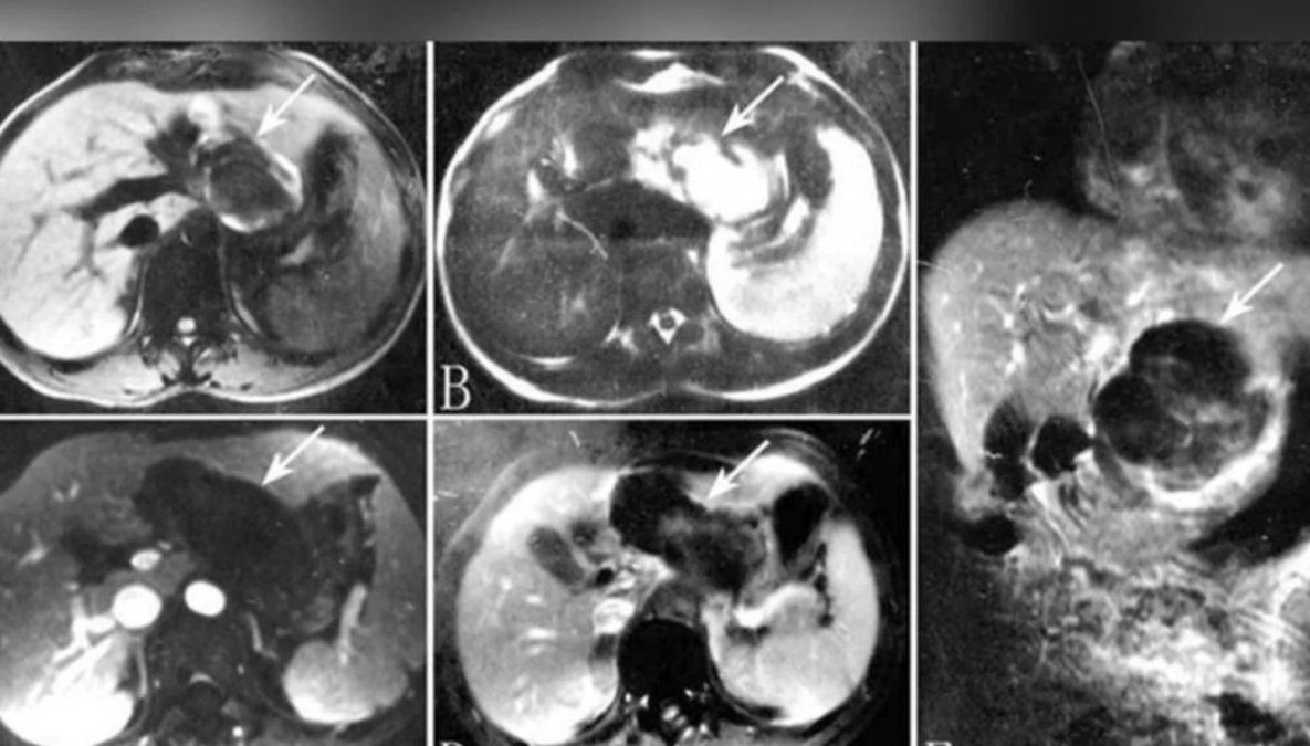 Jamás vi algo así: pediatra atendió a una mujer embarazada con el feto en el hígado