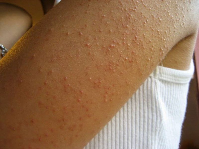 La razón por la que aparecen los molestos granitos en el brazo
