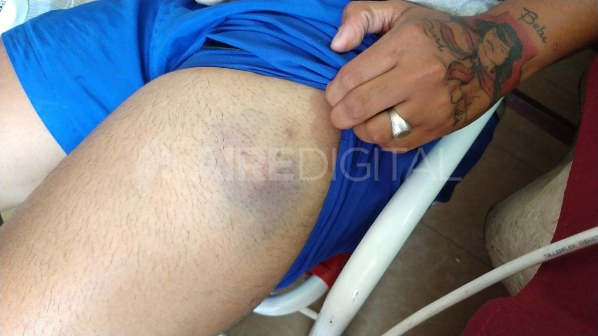 Marcos tiene 27 años y recibió el alta médica luego de recibir un disparo de arma de fuego en la pierna izquierda