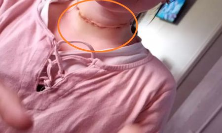 La menor con la herida en el cuello aún cicatrizándose. La menor con la herida en el cuello aún cicatrizándose.
