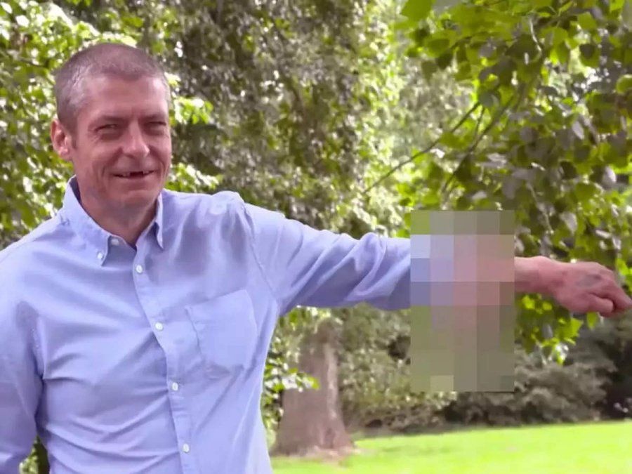Se le cayó el pene, lo tuvo en el brazo por 6 años y ahora se lo ubicaron en el lugar correcto