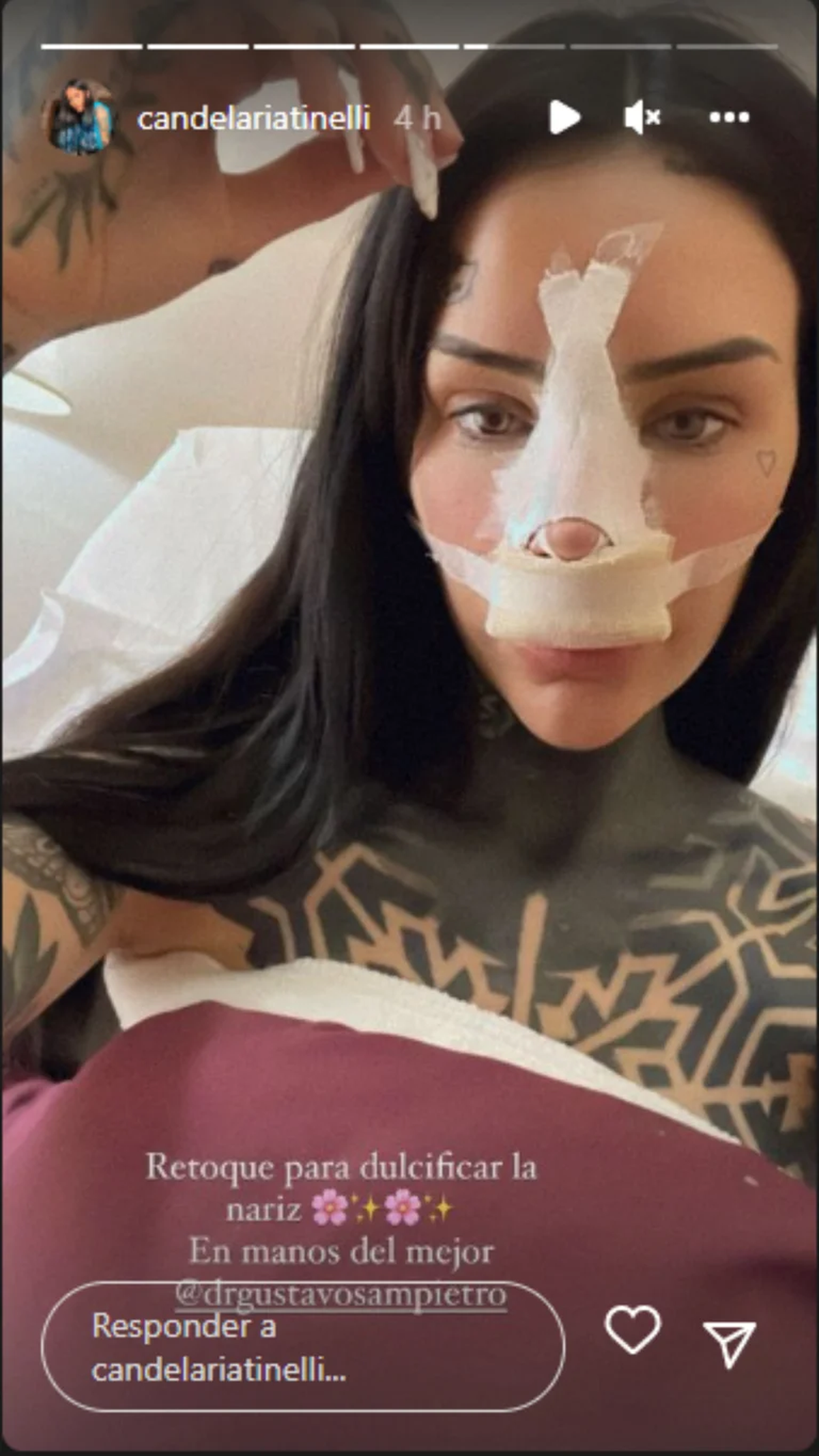 Cande Tinelli mostró cómo está tras una nueva rinoplastia.