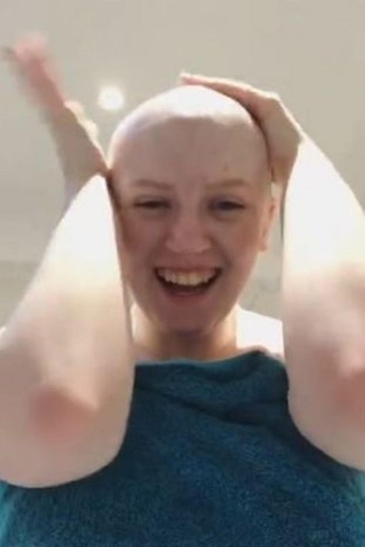 A los 20 años su cuerpo atacó sus folículos y se quedó calva temporalmente. (Foto: Mirror)