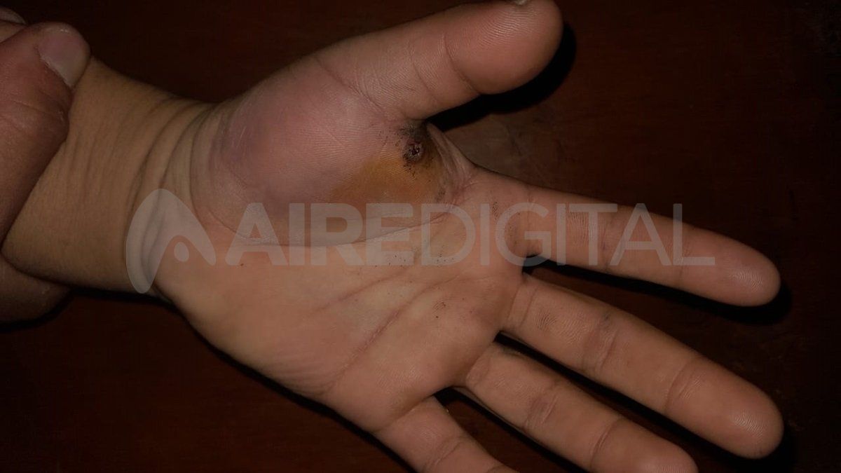Así le quedó la mano al joven víctima del robo. 